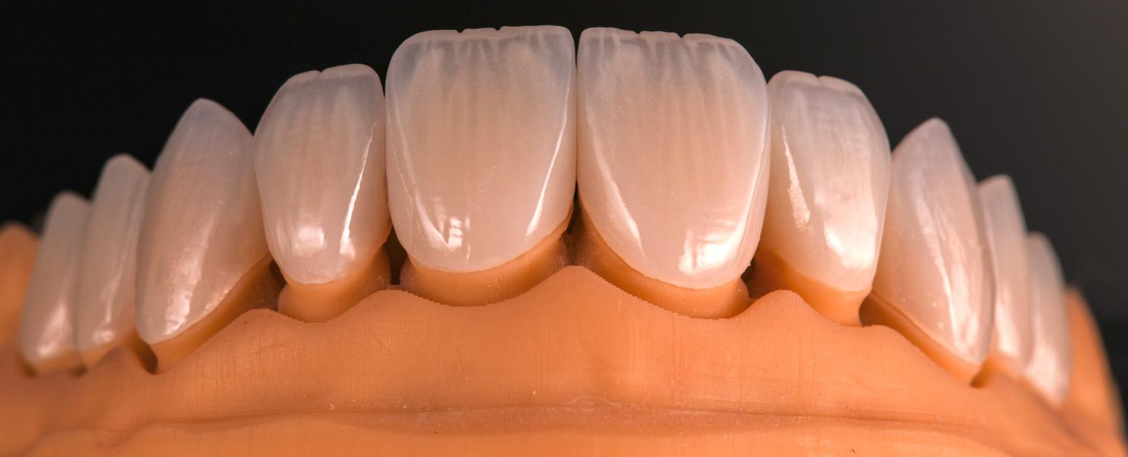 E-Max Veneer